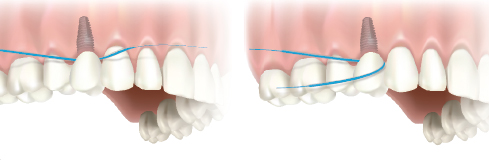 Dental Implants - Dentists Centurion | Centurion Dental Studio ...